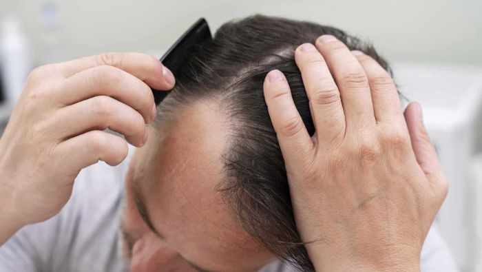 Căng thẳng kéo dài làm tăng nồng độ cortisol, một trong những nguyên nhân phổ biến gây rụng tóc