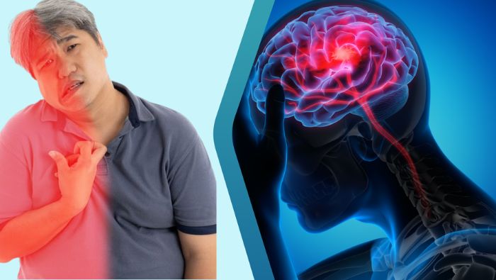 Tổn thương bán cầu não trái thường gây liệt nửa người bên phải
