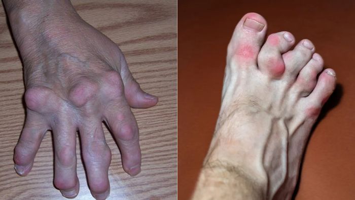 Khối gout tophi kích thước lớn gây biến dạng khớp và làm giảm nghiêm trọng khả năng vận động