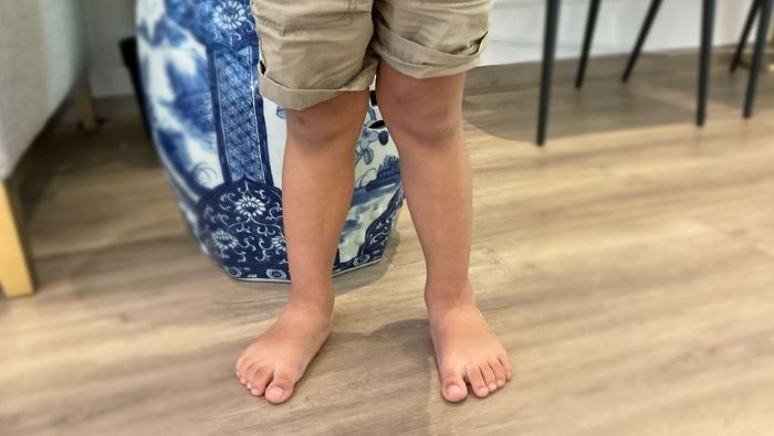 Dấu hiệu khớp gối vẹo ngoài là khi trẻ đứng thẳng, hai đầu gối chạm nhau nhưng hai mắt cá chân nằm cách xa nhau