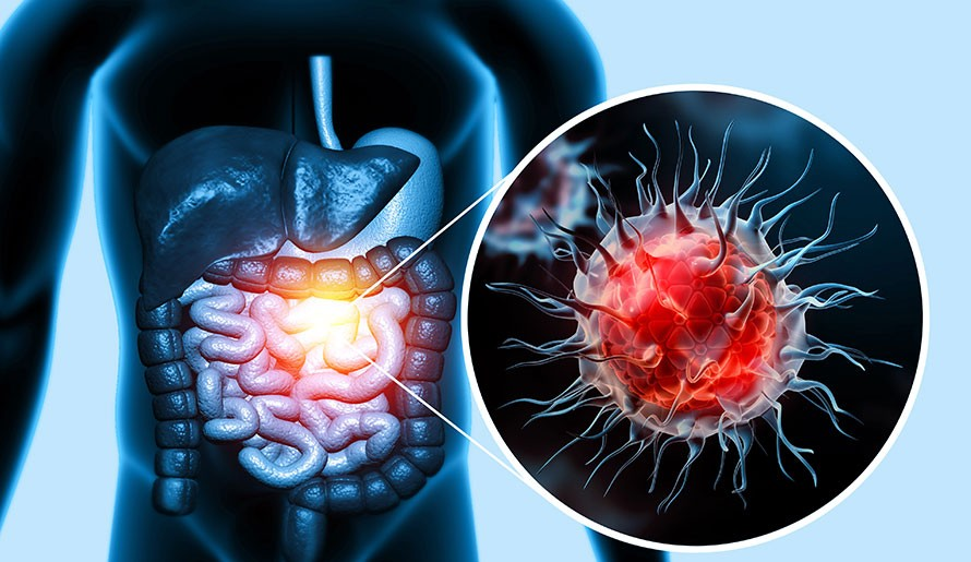 Thói quen đại tiện thay đổi có thể là dấu hiệu cảnh báo ung thư đại trực tràng