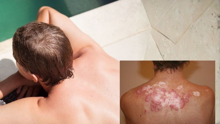 Ánh nắng mặt trời (tia UV) là yếu tố hàng đầu khiến lupus ban đỏ dạng đĩa bùng phát và tổn thương nặng hơn