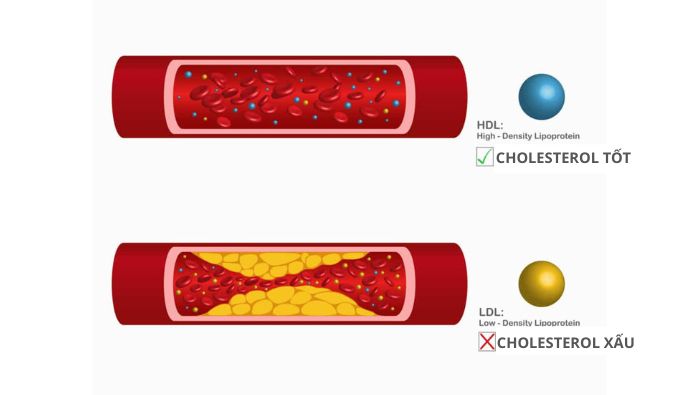 Chất béo bão hòa có thể làm tăng cholesterol LDL xấu trong máu.
