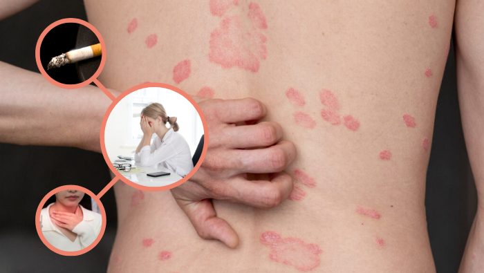 Căng thẳng và lối sống kém lành mạnh là những nguyên nhân kích hoạt vảy nến toàn thân bùng phát