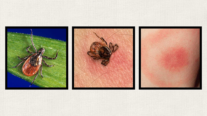 Ve chân đen đang bám vào da và vết phát ban bia bắn điển hình của bệnh Lyme