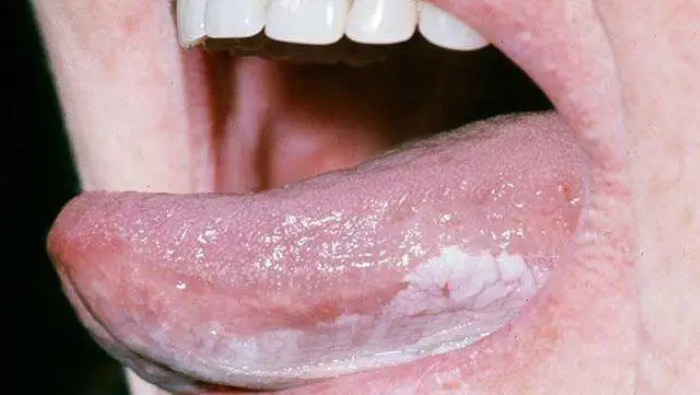 Các mảng trắng không thể cạo sạch là tổn thương tiền ung thư đáng lo ngại ở lưỡi