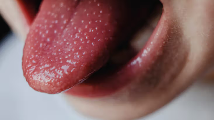 Lưỡi dâu tây với các nốt sần đỏ tươi đi kèm sốt là dấu hiệu cảnh báo viêm họng liên cầu khuẩn