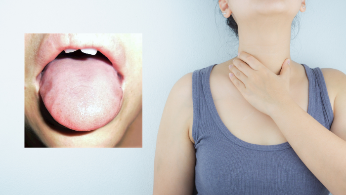 Tình trạng lưỡi sưng to kèm vết in hình răng ở rìa thường liên quan đến bệnh lý tuyến giáp