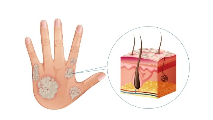 Khi làn da của người bệnh vảy nến gặp phải bất kỳ chấn thương nhỏ nào, cơ thể sẽ kích hoạt một phản ứng viêm mới ngay tại khu vực đó hoặc xung quanh vùng da bị tổn thương