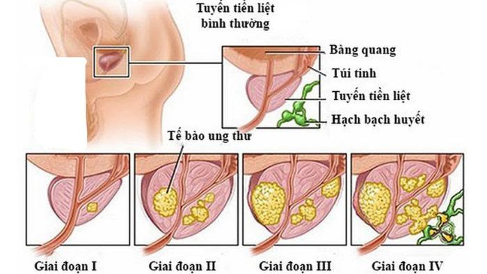 ung thư tuyến tiền liệt còn có tên gọi khác là ung thư tiền liệt tuyến - Ảnh: benhvienk.vn