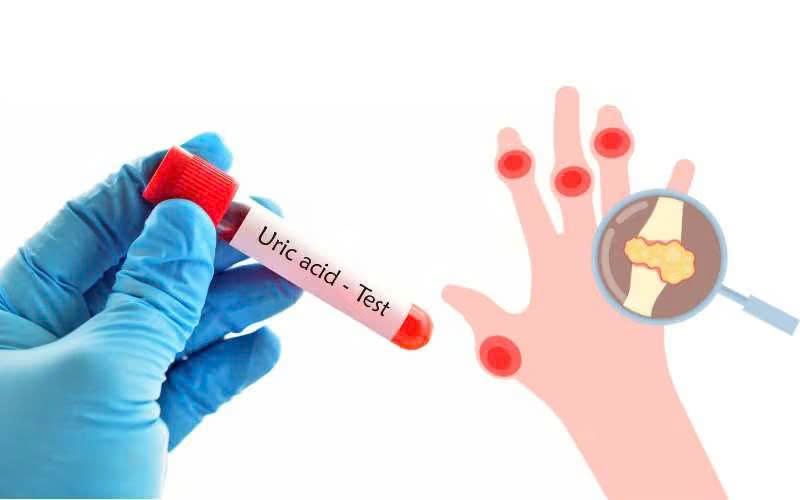 Người bệnh gout cần kiểm soát tốt nồng độ acid uric trong máu
