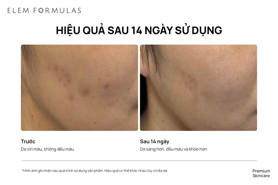 Hình ảnh thực tế từ người dùng ghi nhận sự thay đổi tích cực về độ sáng và nền da sau một thời gian sử dụng. Hiệu quả sử dụng có thể khác nhau tùy tình trạng và cơ địa da.