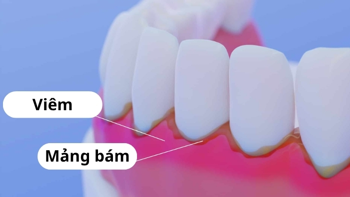 Mảng bám tích tụ lâu ngày hóa cứng thành cao răng là nguyên nhân hàng đầu gây viêm chân răng 
