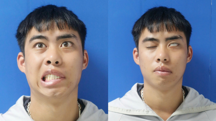 Khuôn mặt mất cân đối rõ rệt, miệng lệch sang một bên khi cười, mắt không thể nhắm kín - Ảnh: BVCC.