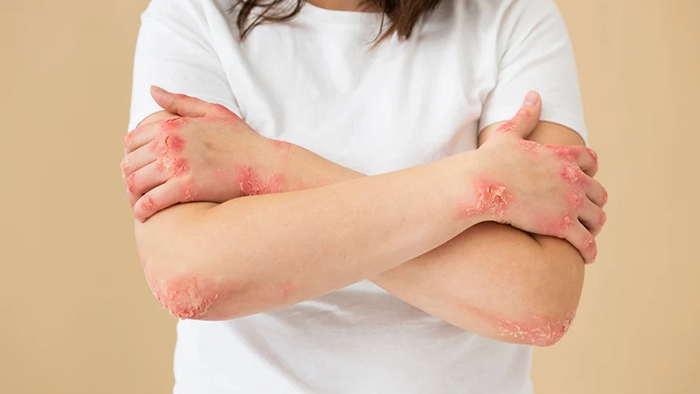Vảy nến là bệnh viêm da mạn tính liên quan đến hệ miễn dịch, hoàn toàn không lây qua tiếp xúc hay sinh hoạt chung