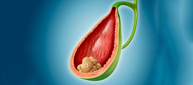 Sỏi mật có thể là một trong những nguyên nhân gây đầy bụng, khó tiêu kéo dài