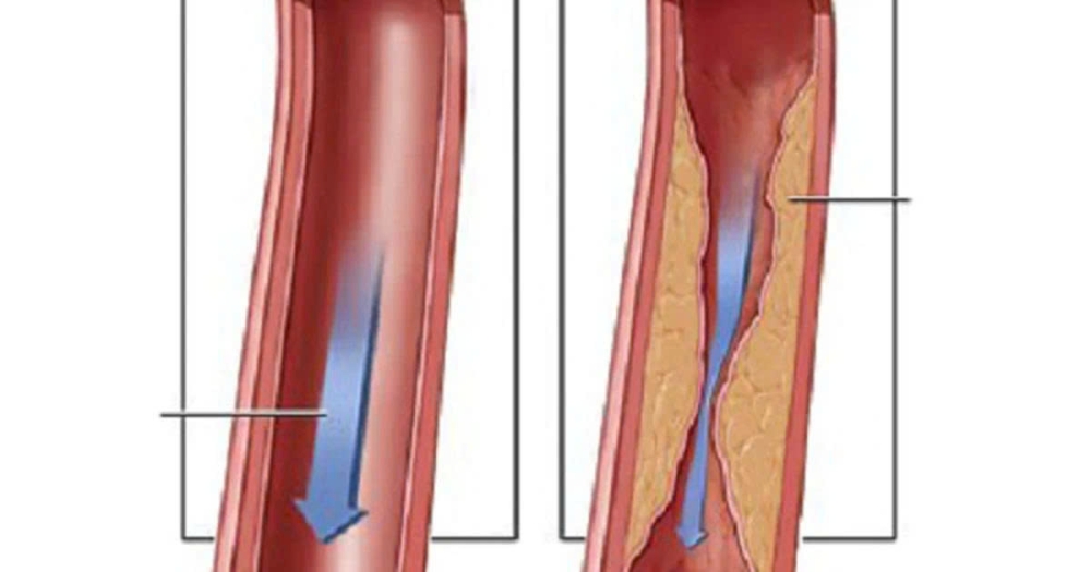  Hẹp mạch vành là tình trạng một hoặc nhiều nhánh của động mạch vành bị hẹp