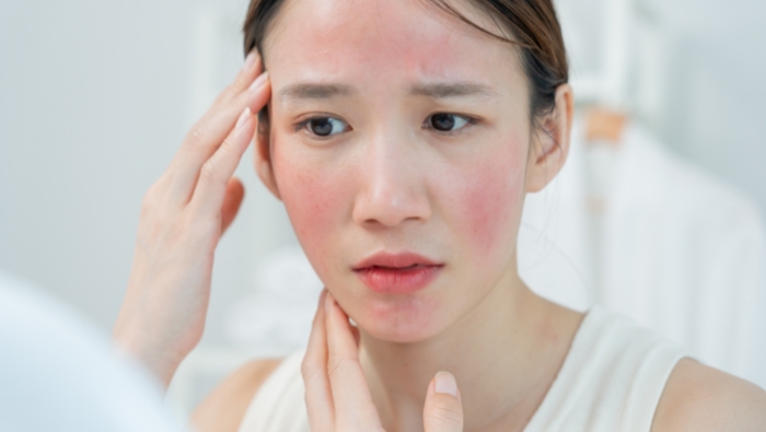 Acid azelaic hỗ trợ chăm sóc làn da bị mụn trứng cá và chứng đỏ da rosacea