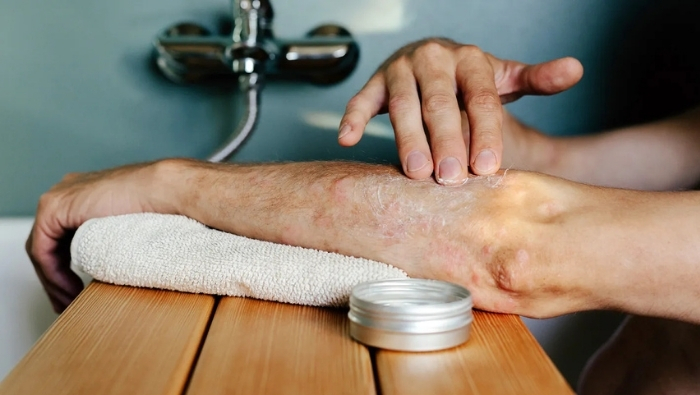Dùng sữa tắm dịu nhẹ không hương liệu và thoa kem dưỡng ẩm giúp bảo vệ màng ẩm cho da vảy nến