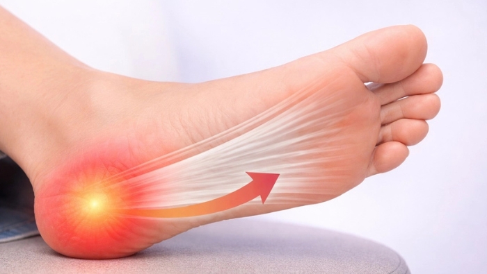 Cơn đau nhói gót chân ở những bước đi đầu tiên vào buổi sáng là dấu hiệu đặc trưng của tình trạng viêm cân gan chân