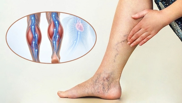 Thói quen ít vận động, ngồi lâu một chỗ làm làm giảm hoạt động bơm của bắp chân, làm tăng nguy cơ suy tĩnh mạch  