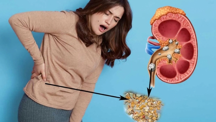 Đi tiểu nhiều hơn khi uống trà râu ngô không đồng nghĩa với việc chức năng của thận đang tốt lên hay có thể chữa sỏi thận