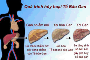Phòng và chữa gan nhiễm mỡ theo Đông y