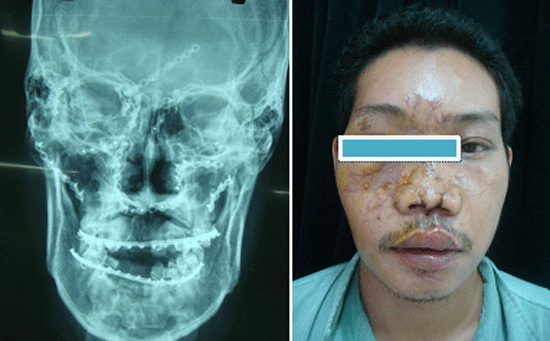 Dùng lưới titan phục hồi mặt bị biến dạng