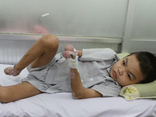 Hội chứng hiếm gặp - rụng tay chân (vohwinkel)