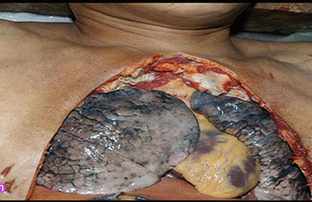 Cận cảnh sự hủy hoại ghê rợn của thuốc lá