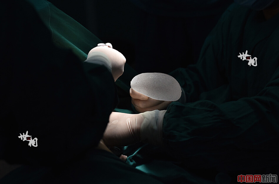 Các bác sĩ phẫu thuật nhét túi ngực silicone qua một đường rạch và đặt nó dưới cơ ngực Wang. 