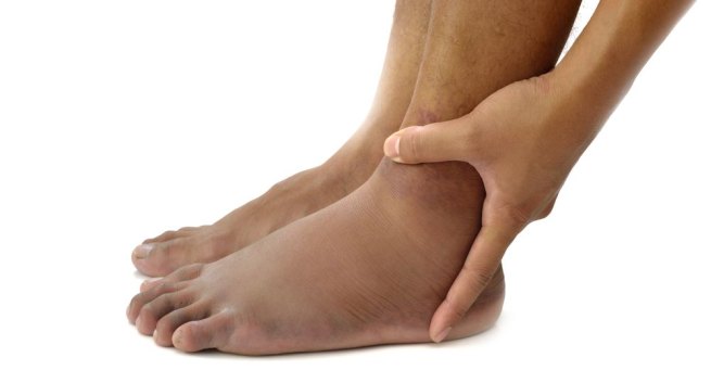 5 triệu chứng của bệnh suy giãn tĩnh mạch chân bạn nên biết - Ảnh 6
