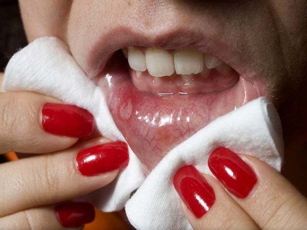 8 nguyên nhân gây loét miệng bạn cần phải biết - Ảnh 4