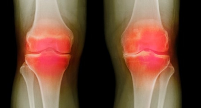 Viêm xương khớp: Chỉ số BMI vượt quá mức 25 có thể dẫn đến tình trạng viêm xương khớp. Viêm xương khớp có thể gây đau khớp và ảnh hưởng đến khả năng di chuyển, hoạt động thể chất của bạn hàng ngày.