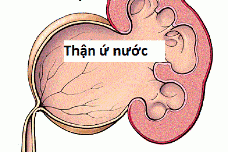 Thận ứ nước có nguy hiểm không?