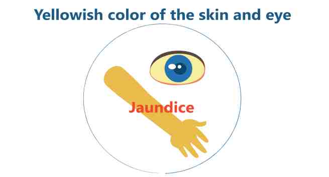 Vàng da, vàng mắt: Không phải tất cả những người bị vàng da, vàng mắt đều có nguy cơ bị ung thư gan. Trong một số trường hợp, đó có thể là một dấu hiệu sớm của những tổn thương gan nhưng nếu không điều trị kịp thời, bệnh dễ tiến triển thành ung thư gan. Do đó, bạn không nên bỏ qua các triệu chứng như vàng da, vàng mắt, phân nhạt màu và nước tiểu sẫm màu.