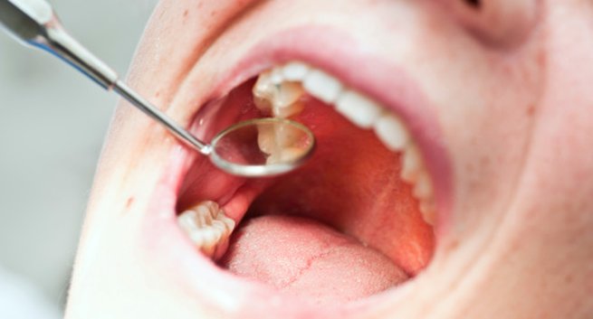 Sâu răng: Sâu răng không được điều trị, hoặc một chiếc răng bị sứt mẻ cũng có thể khiến các vi khuẩn tấn công nướu răng. Tình trạng nhiễm khuẩn này có thể dẫn đến sự tích tụ mủ và gây sưng quanh răng, nướu răng và cả khuôn mặt.