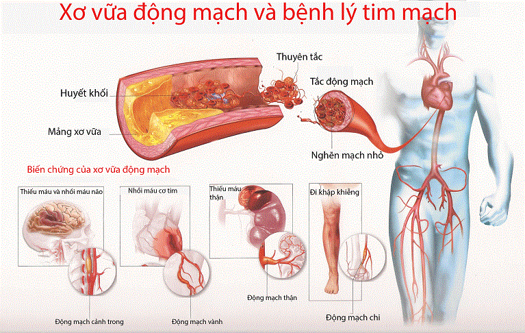 Xơ vữa động mạch âm thầm nhưng nguy hiểm
