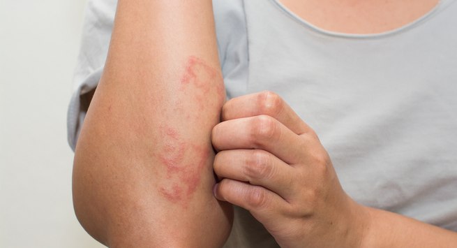 Phát ban da: Phát ban xuất hiện trên da do cơ thể phản ứng với thuốc kháng sinh. Những vết đỏ trên da do tình trạng dị ứng này có thể mẩn đỏ và gây ngứa.