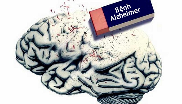 Nguyên nhân nào gây bệnh sa sút trí tuệ (Dementia) ở người cao tuổi? - Ảnh 2