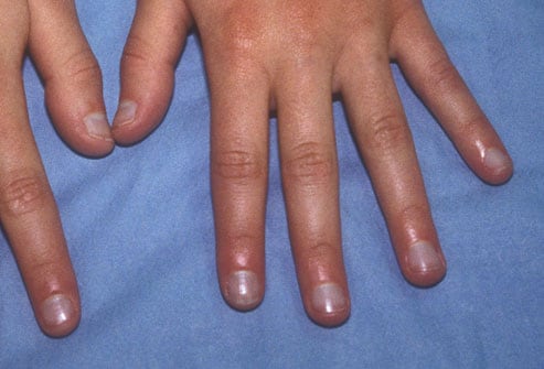 Các dấu hiệu của móng tay báo hiệu gì về sức khỏe bạn? - Ảnh 5