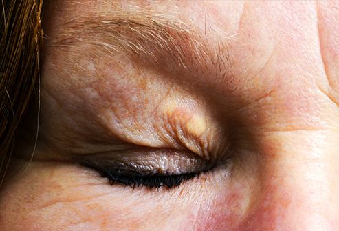 Các đốm vàng trên mí mắt: Những vết mụn màu vàng nổi lên trên và xung quanh mí mắt có thể là dấu hiệu cho thấy nguy cơ cao mắc bệnh tim hoặc đau tim.