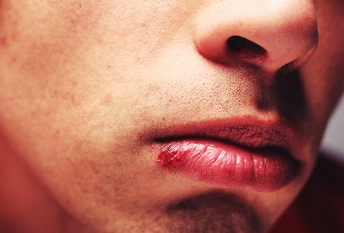 Vết loét: Những vết loét quanh môi và miệng rất có thể là mụn rộp do virus herpes gây ra. Chúng thường tự biến mất, nhưng nếu tình trạng nặng hơn hoặc bị thường xuyên, hãy đến gặp bác sĩ.
