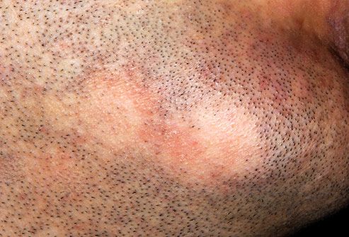 Rụng lông, tóc: Nếu bạn rụng nhiều lông mi, lông mày, râu, lông mặt, thậm chí các mảng tóc, có thể bạn đang bị chứng bệnh gọi là rụng tóc từng vùng (alopecia areata). 