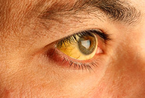 Da và mắt hơi vàng: Vàng da là tình trạng gan chưa xử lý hiệu quả các tế bào hồng cầu bị vỡ. Vàng da có thể báo hiệu các tình trạng nghiêm trọng như viêm gan, tăng bạch cầu đơn nhân, các vấn đề với gan, túi mật, tuyến tụy hoặc lạm dụng rượu.