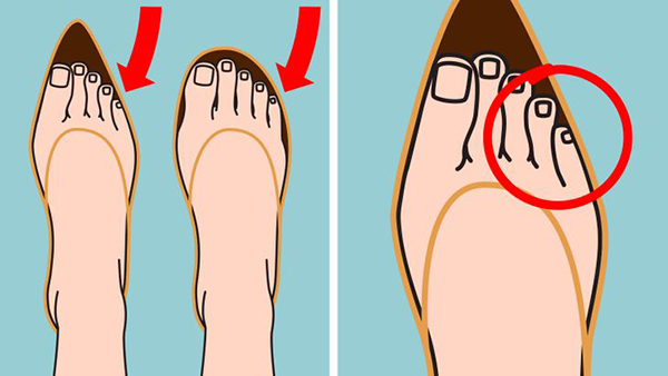 Móng chân trở nên mỏng manh và dễ gãy: Ngoài những vấn đề về sức khỏe, thẩm mỹ của bàn chân cũng chịu ảnh hưởng. Khi bị “chèn ép” bởi giày cao gót, móng chân dễ trở nên mỏng và giòn hơn, đặc biệt là đối với ngón út. 