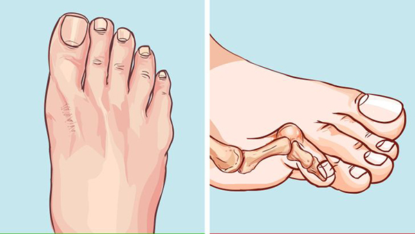 Dễ xuất hiện ngón chân quắp/khoằm: Do sự mất cân bằng của cơ, gân và dây chằng kết hợp, bàn chân của bạn có thể sẽ gặp phải tình trạng quắp/khoằm ngón chân, vốn là một dạng dị tật. Nguyên nhân của điều này là do ngón chân không được duy trì ở tư thế tự nhiên, liên tục bị “ép” gọn và chặt vào phần trước của giày.