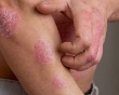 Ngày vảy nến thế giới: Nâng cao kiến thức cho người bệnh!