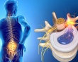 7 nguyên nhân dẫn đến thoát vị đĩa đệm