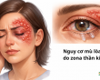 Nguy cơ mù lòa do zona thần kinh